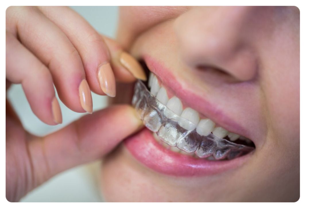 how clear aligners gave me the smile of my dreams